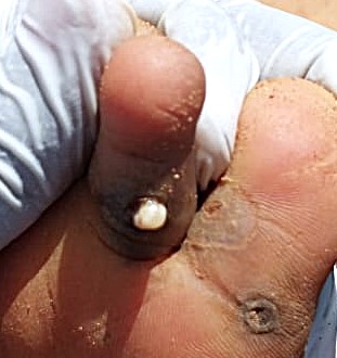 Was sind Jiggers - und warum sind sie gefährlich?